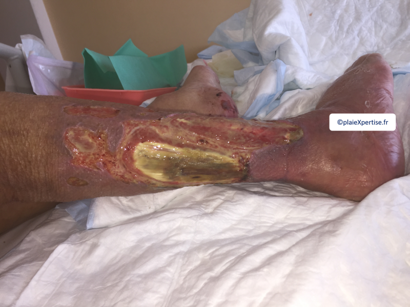 Fichier:Tendon nécrotique humide43.png