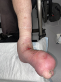 Lymphoedème pied20.png