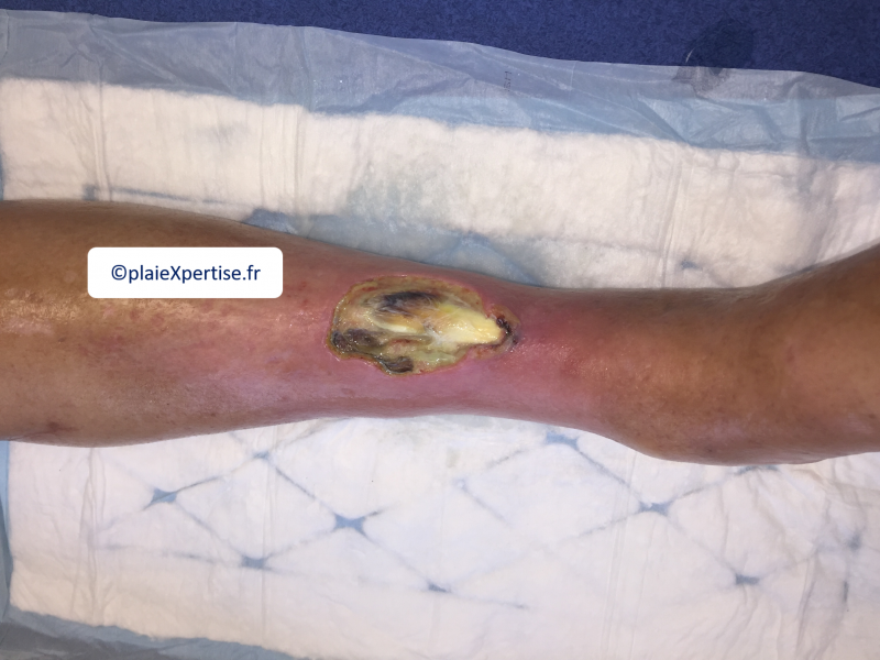 Fichier:Tendon nécrotique humide23.png