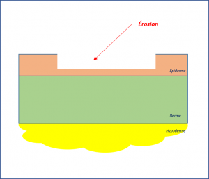Erosion .png