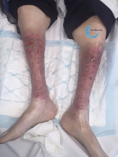 Fichier:Hypodermite chronique52.jpg