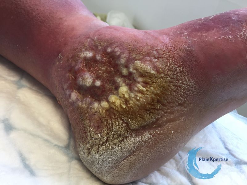 Fichier:Lymphoedème47.jpg