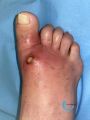 Pied infecté22.jpg