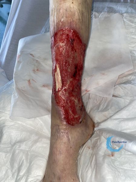 Fichier:Tendon normal48.jpg