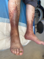 Dermiteocre53.png