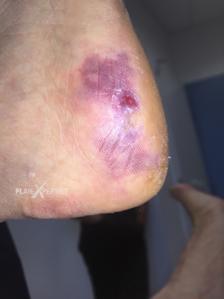Fichier:Embols de cristaux de cholestérol4.png