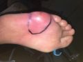 Pied infecté38.jpg