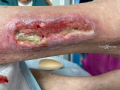 Tendon-Reliquat9.png