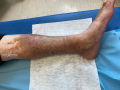 Dermiteocre45.png