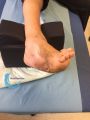 Pied de Charcot28.jpg