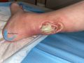 Tendon normal29.jpg