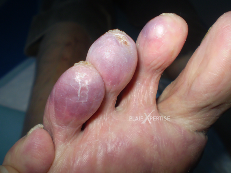 Fichier:Embols de cristaux de cholestérol8.png