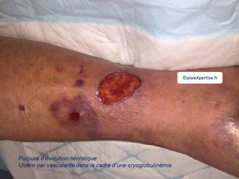 Fichier:Vascularite17.png