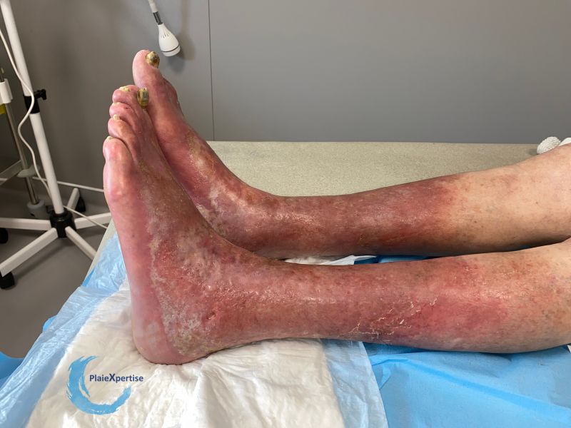 Fichier:Eczéma139.jpg