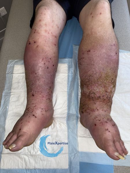Fichier:Lymphoedème57.jpg