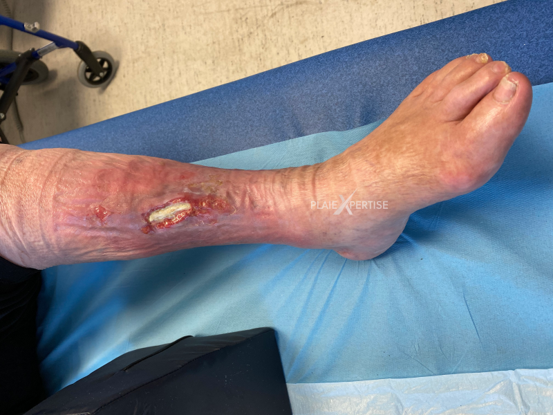 Fichier:Tendon normal25.png