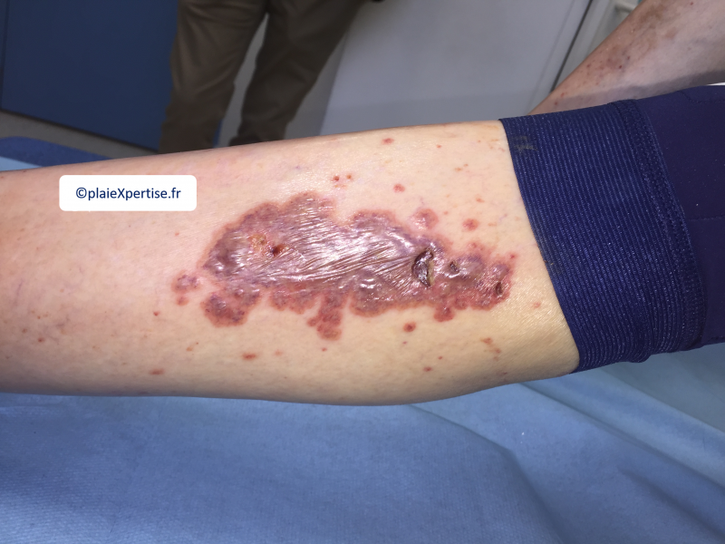 Fichier:Vascularite12.png