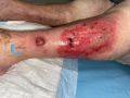 Calcifications47.jpg