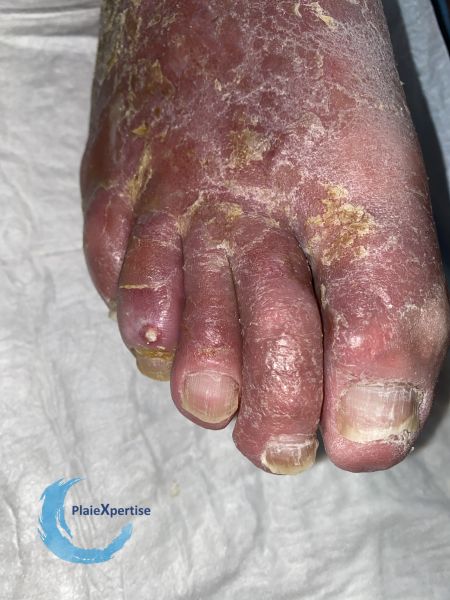 Fichier:Eczéma119.jpg