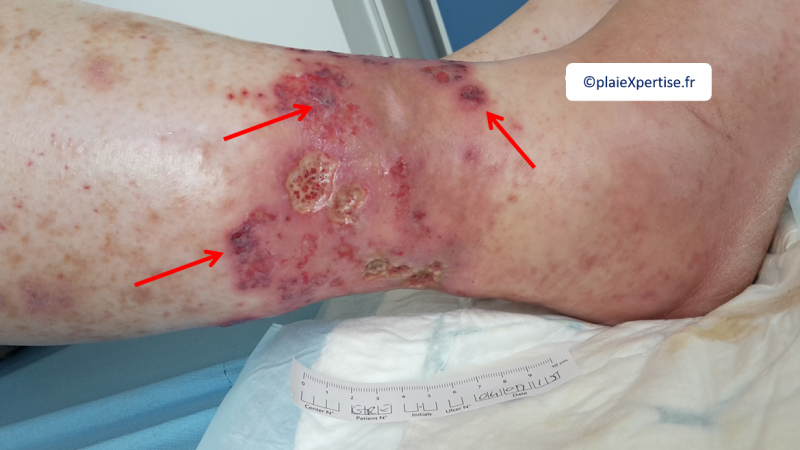 Fichier:Purpura pustuleux2.png
