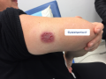 Pyoderma gangrenosum12.png