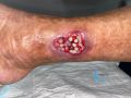 Angiodermite typique123.jpg