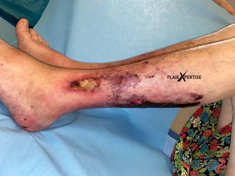 Fichier:Angiodermite typique45.png