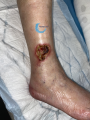 Angiodermite typique65.png
