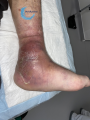 Pied de Charcot7.png