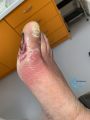 Pied infecté8.jpg