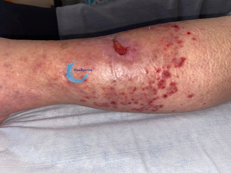 Fichier:Eczéma158.jpg