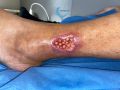 Angiodermite typique122.jpg