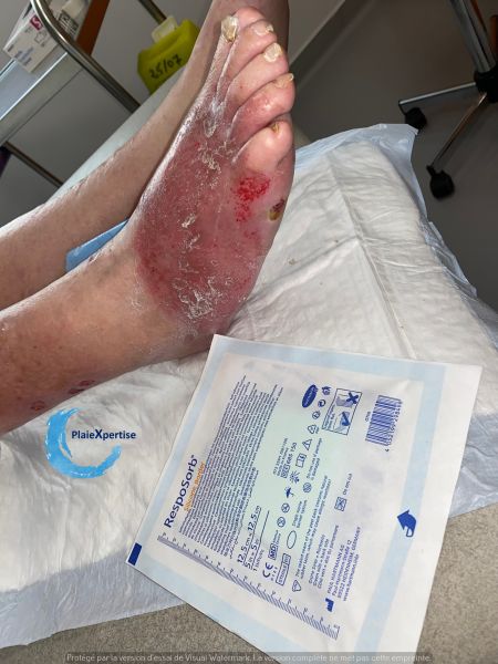 Fichier:Dermite d'irritation211.jpg