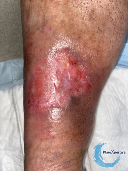 Fichier:Epidermisation18.jpg