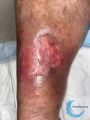 Epidermisation18.jpg