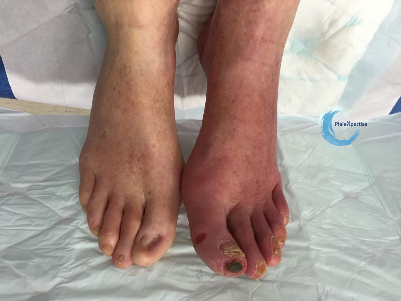 Fichier:Erythrocyanose28.jpg
