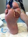 Amputation31.jpg