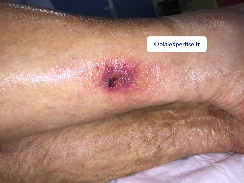 Fichier:Angiodermite typique18.png