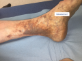Dermiteocre4.png