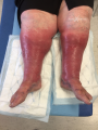 Grosses jambes suintantes17.png