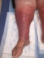Grosses jambes suintantes18.png