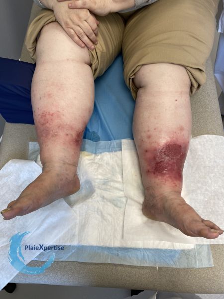Fichier:Grosses jambes suintantes52.jpg