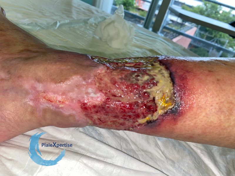 Fichier:Angiodermite typique95.jpg
