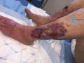 Calciphylaxie3.png