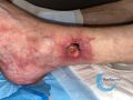 Angiodermite typique101.jpg
