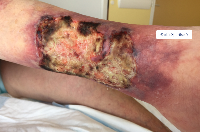 Fichier:Angiodermite typique3.png