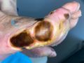 Brulure46.jpg