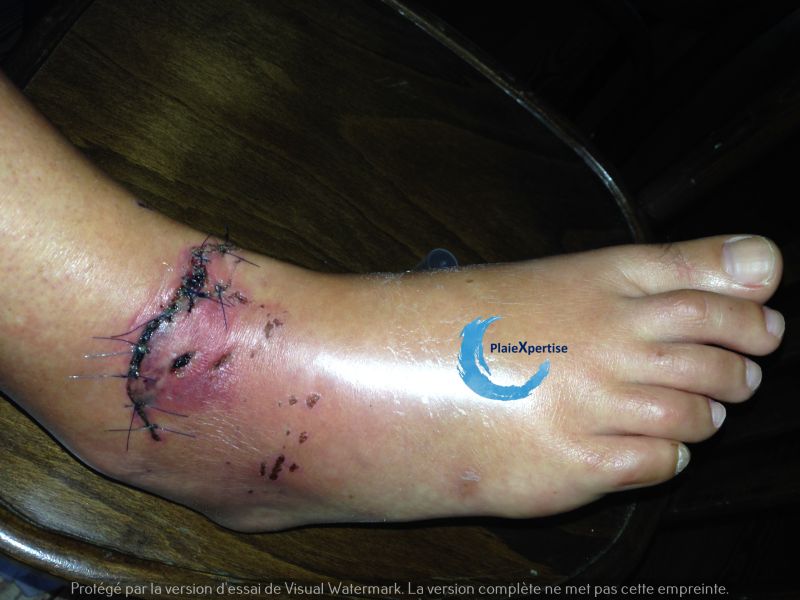 Fichier:Cou de pied102.jpg