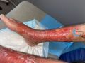 Dermite d'irritation122.jpg