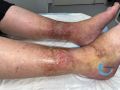 Eczéma82.jpg